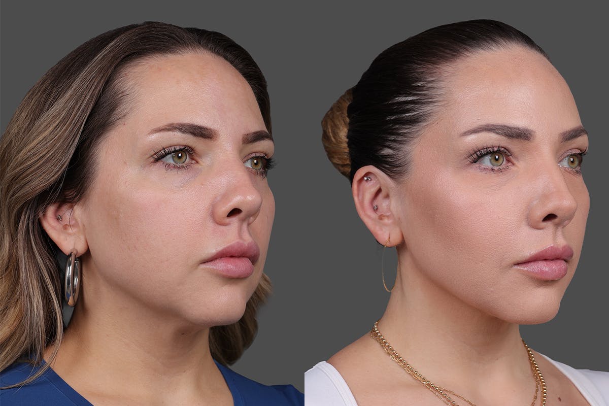 BOTOX® Before & After Gallery - Patient 102465 - Image 2
