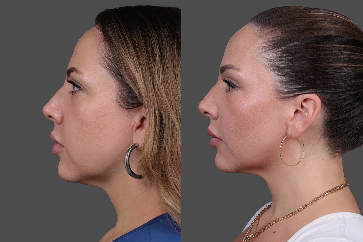 BOTOX® Before & After Gallery - Patient 102465 - Image 3