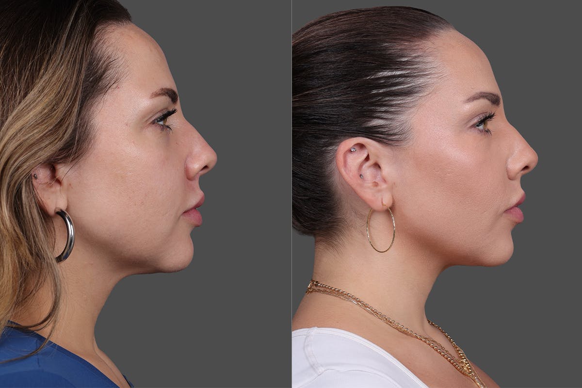 BOTOX® Before & After Gallery - Patient 102465 - Image 5