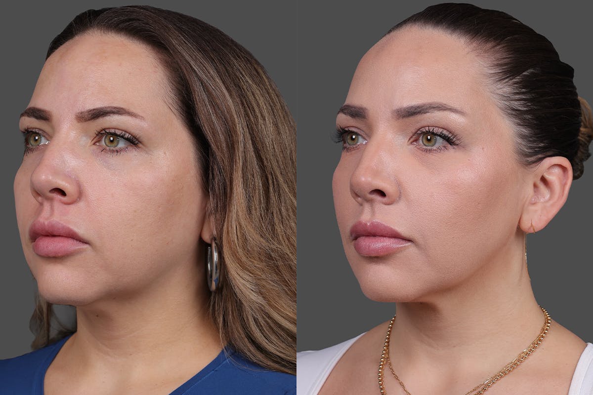 BOTOX® Before & After Gallery - Patient 102465 - Image 4