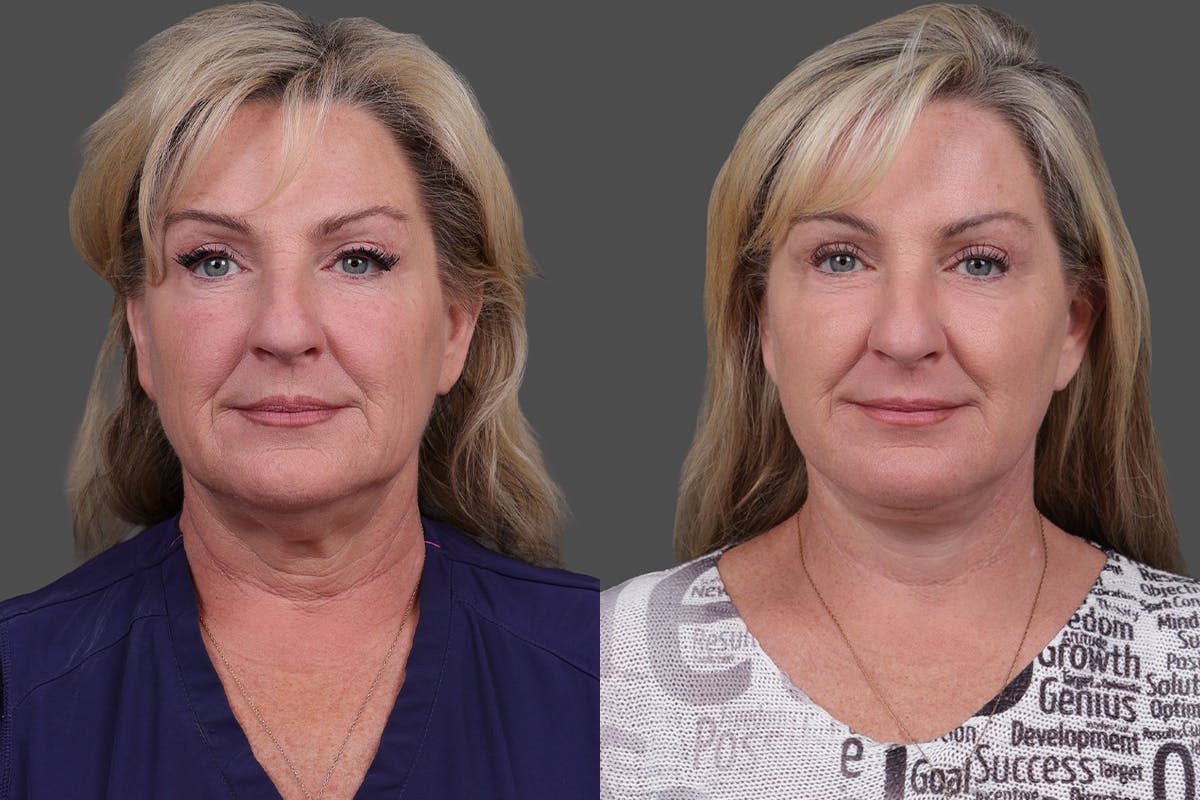 Facelift Before & After Gallery - Patient 141868 - Image 1