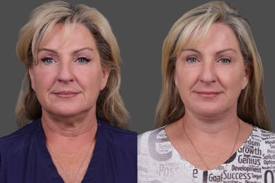 Facelift Before & After Gallery - Patient 141868 - Image 1