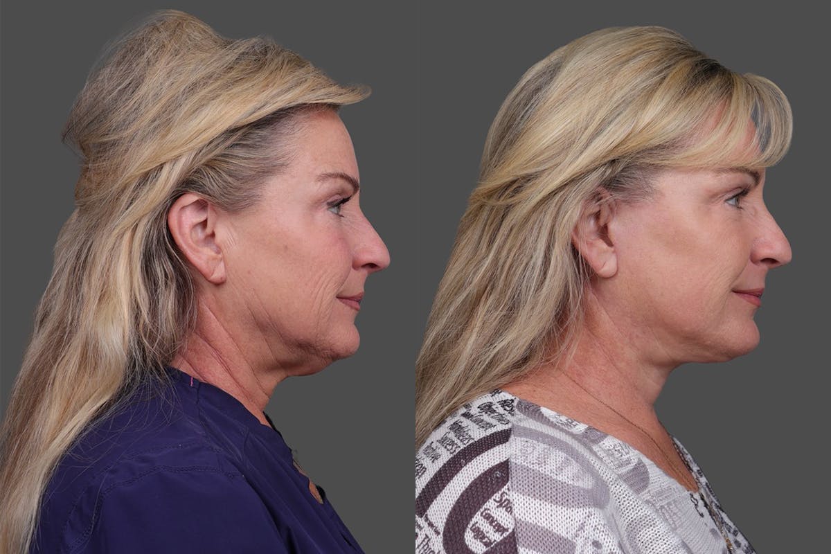 Facelift Before & After Gallery - Patient 141868 - Image 3