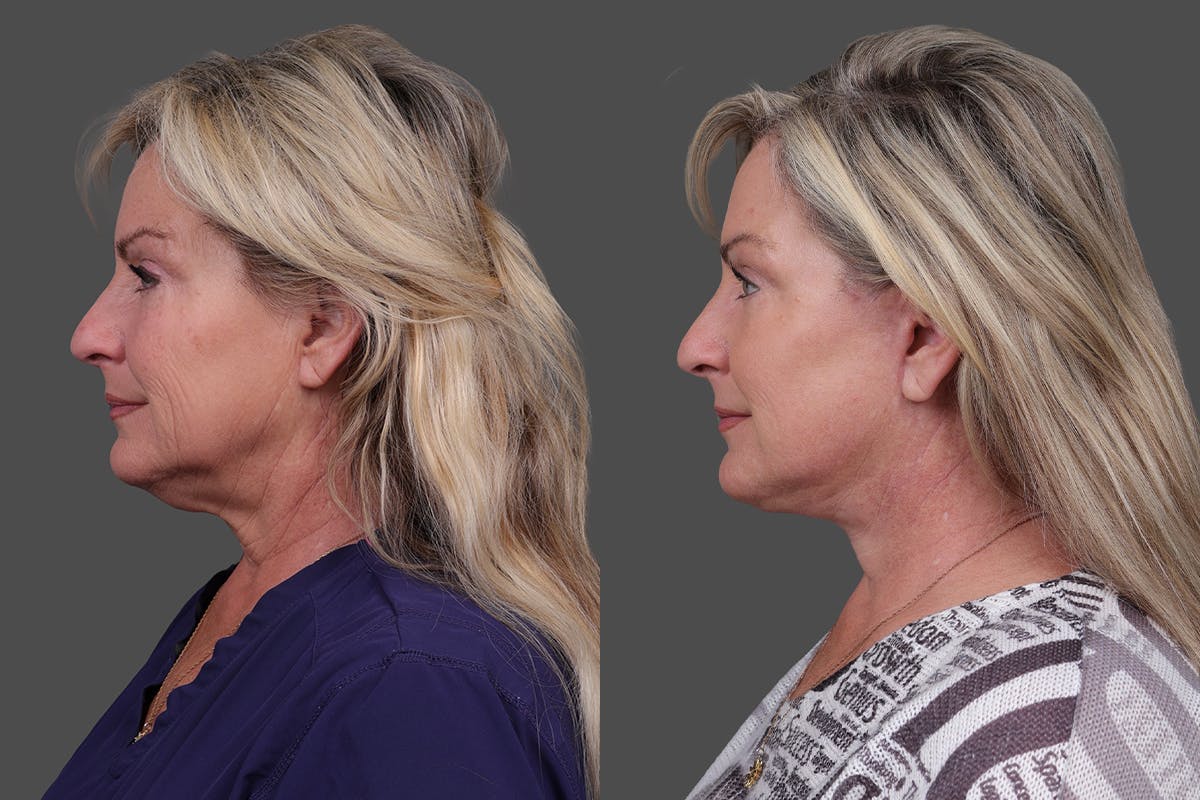 Facelift Before & After Gallery - Patient 141868 - Image 5