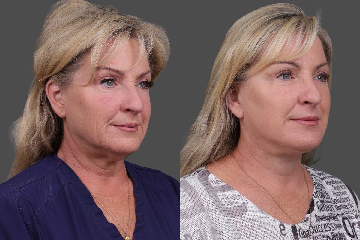 Facelift Before & After Gallery - Patient 141868 - Image 2