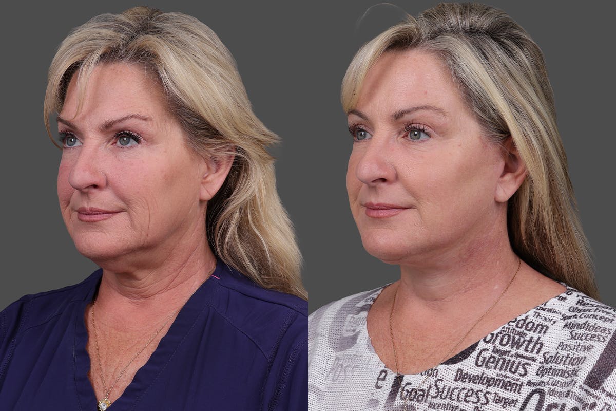 Facelift Before & After Gallery - Patient 141868 - Image 4