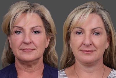 TCA Peel / Dermabrasion Before & After Gallery - Patient 766030 - Image 1