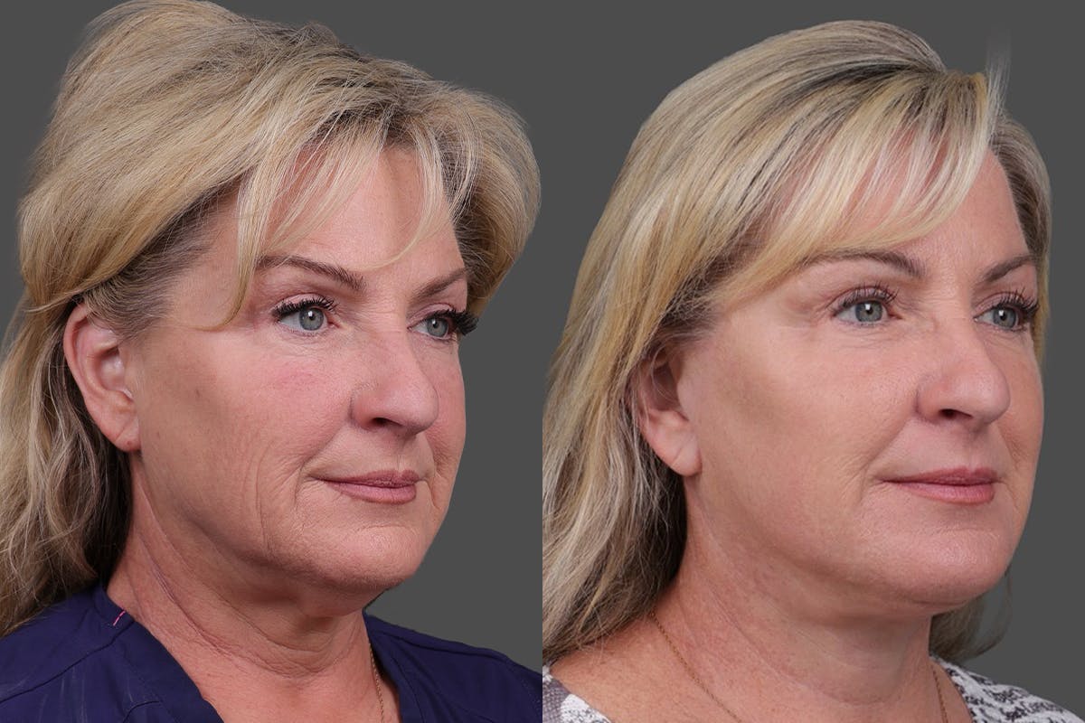 TCA Peel / Dermabrasion Before & After Gallery - Patient 766030 - Image 2
