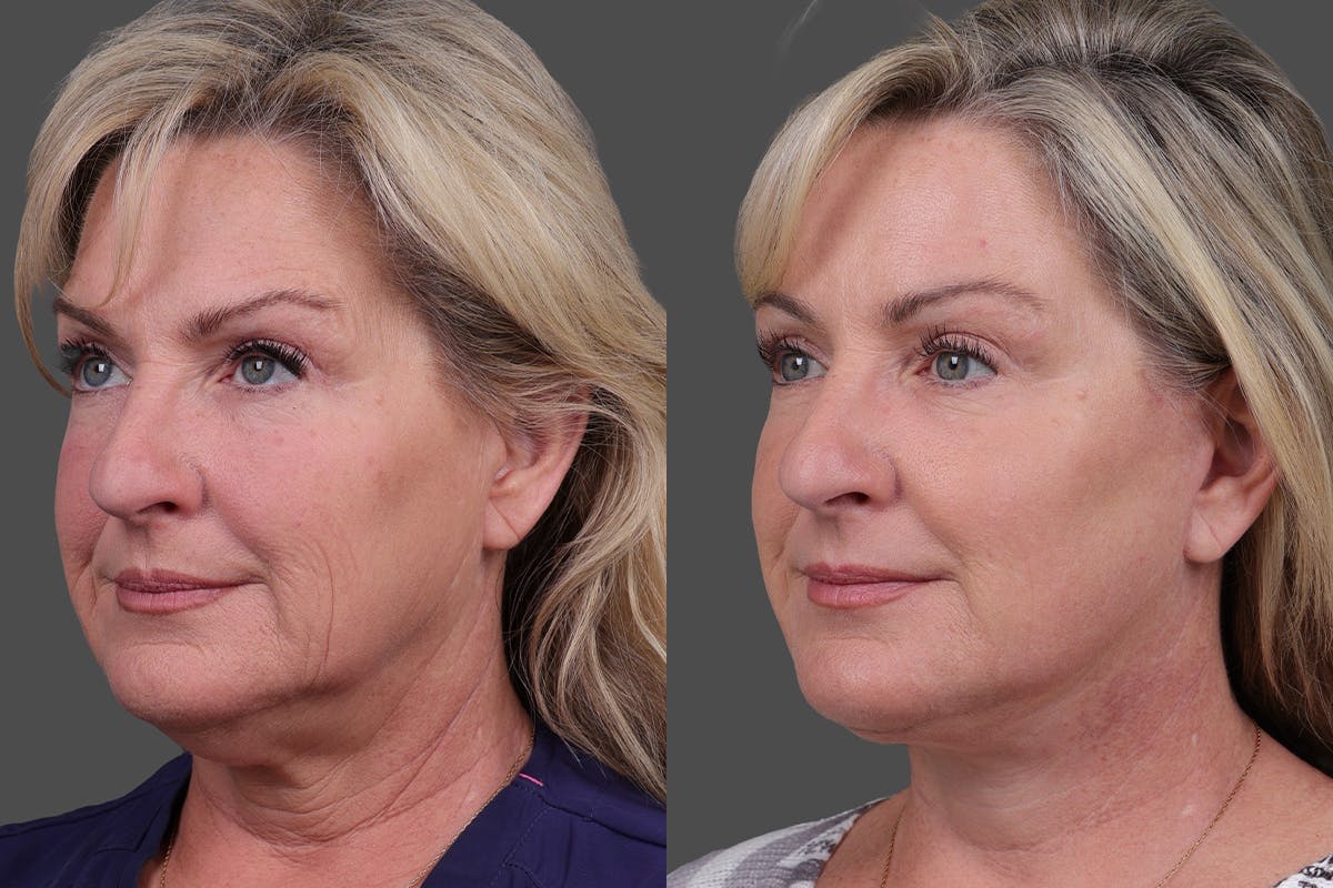 TCA Peel / Dermabrasion Before & After Gallery - Patient 766030 - Image 4