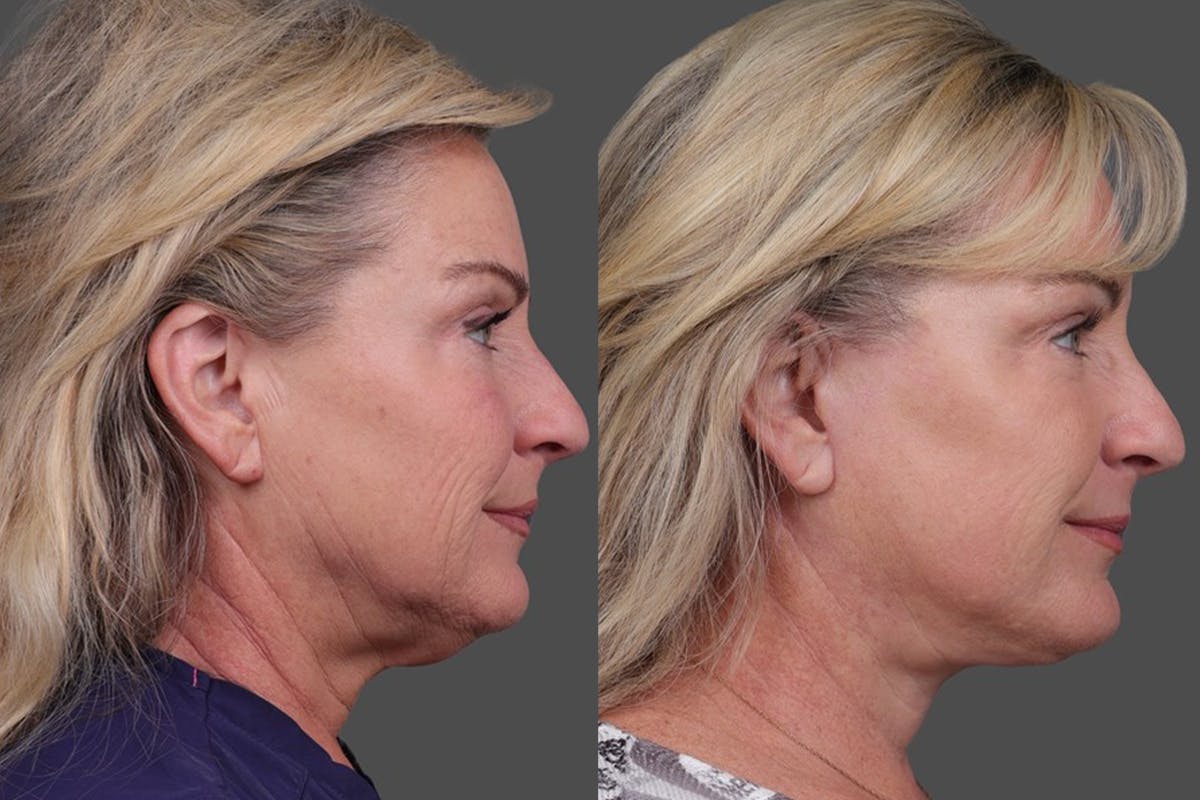 TCA Peel / Dermabrasion Before & After Gallery - Patient 766030 - Image 3