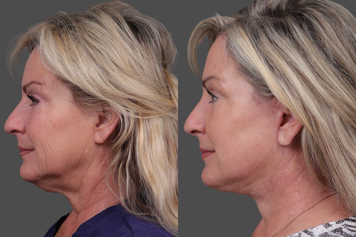 TCA Peel / Dermabrasion Before & After Gallery - Patient 766030 - Image 5