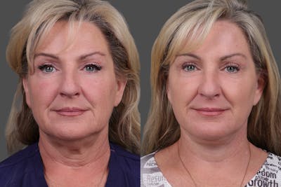 Facelift Before & After Gallery - Patient 141868 - Image 1