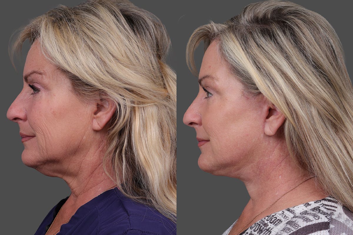 Facelift Before & After Gallery - Patient 141868 - Image 5