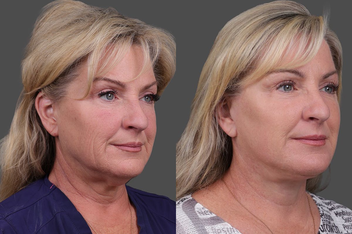 Facelift Before & After Gallery - Patient 141868 - Image 2
