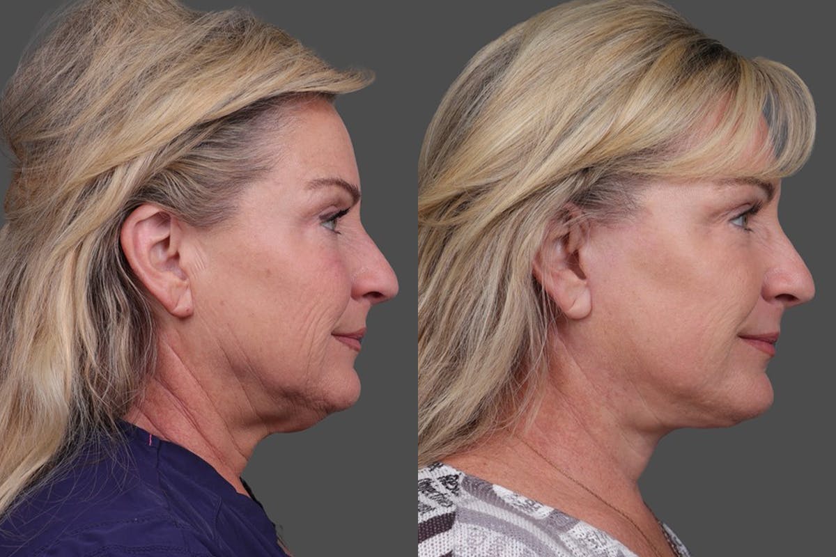 Facelift Before & After Gallery - Patient 141868 - Image 3