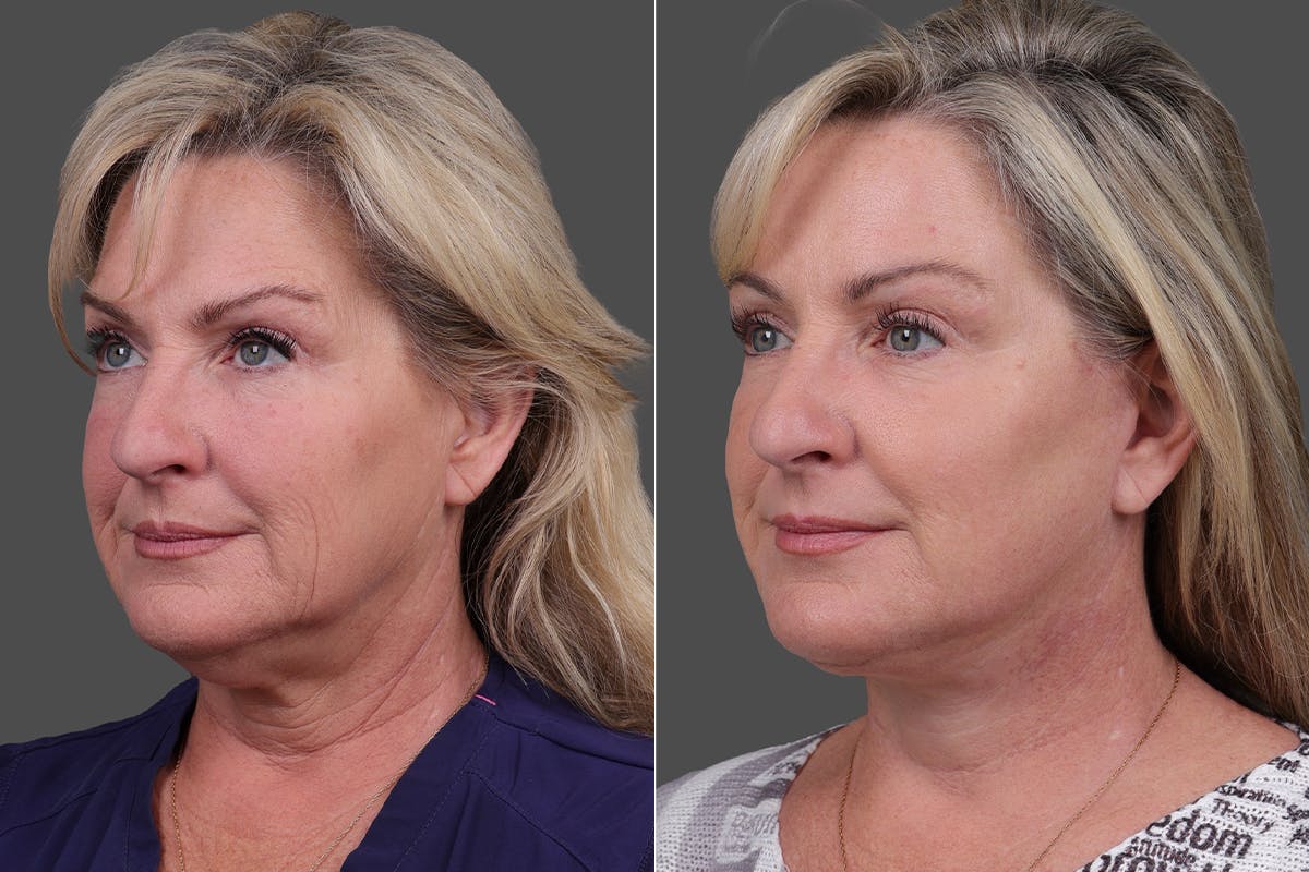 Facelift Before & After Gallery - Patient 141868 - Image 4