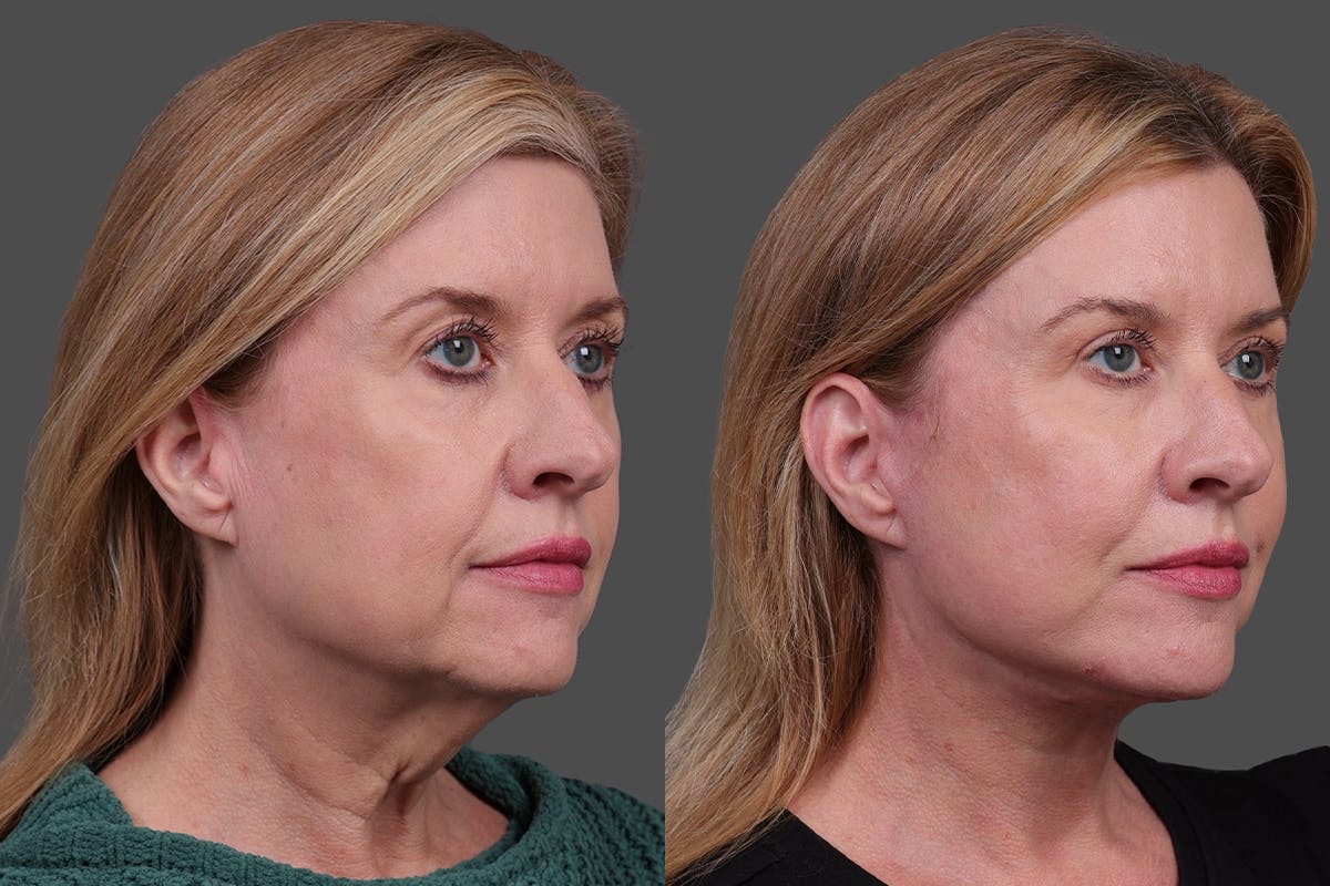 Facelift Before & After Gallery - Patient 244198 - Image 2