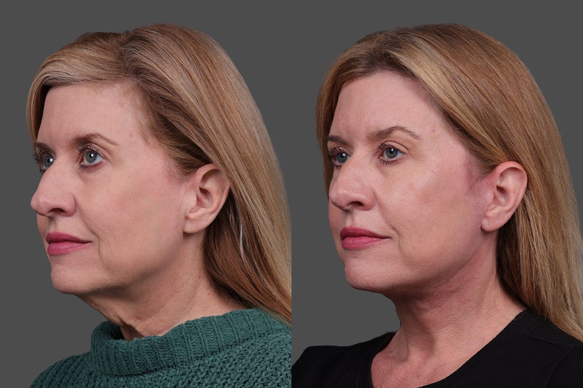 Facelift Before & After Gallery - Patient 244198 - Image 4