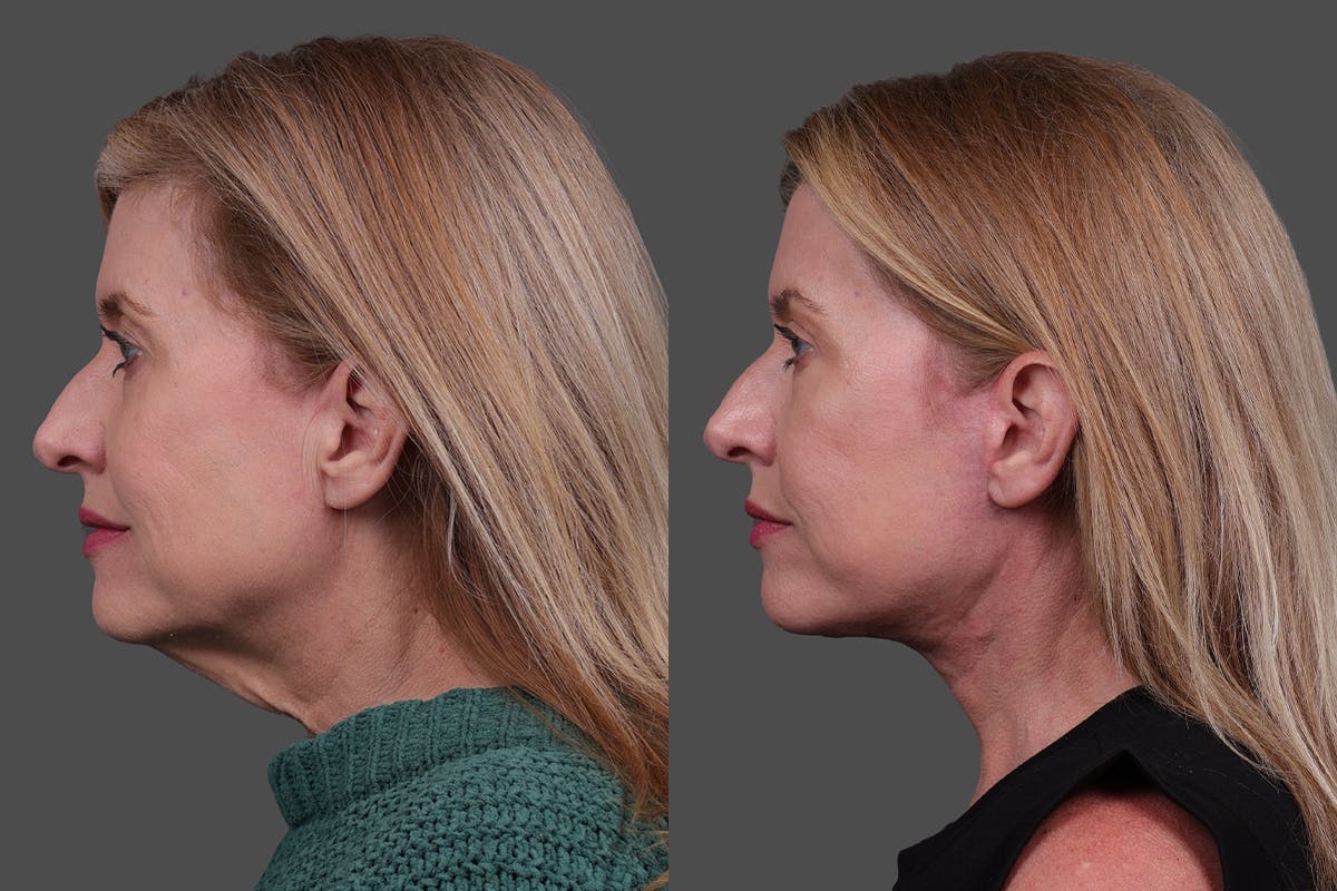 Facelift Before & After Gallery - Patient 244198 - Image 5