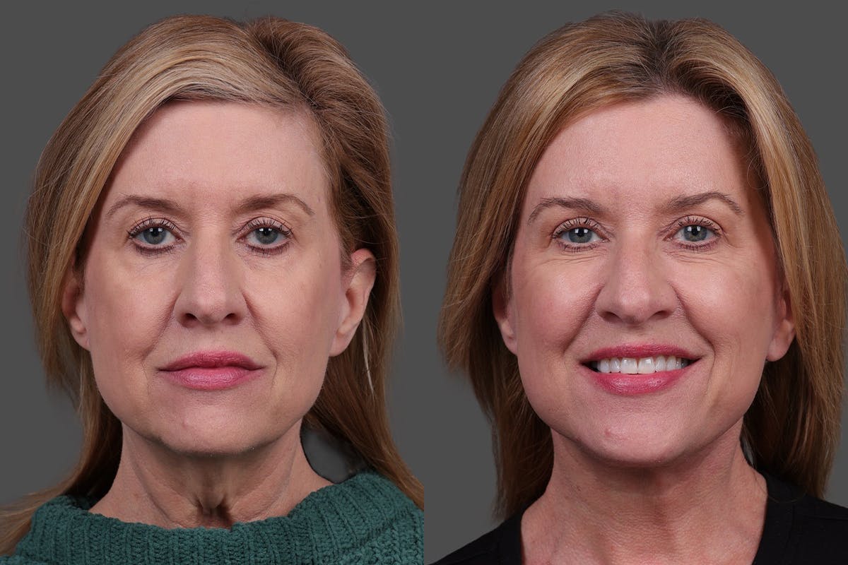 Facelift Before & After Gallery - Patient 244198 - Image 1