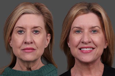 Facelift Before & After Gallery - Patient 244198 - Image 1
