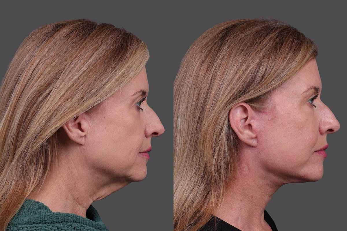 Facelift Before & After Gallery - Patient 244198 - Image 3