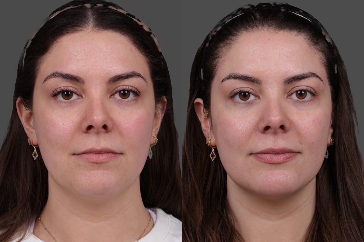 Restylane® Before & After Gallery - Patient 139624 - Image 1