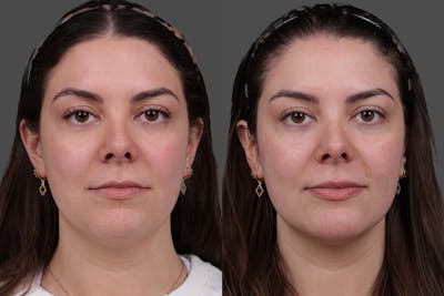 Restylane® Before & After Gallery - Patient 139624 - Image 1
