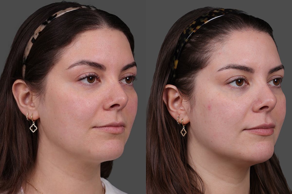 Restylane® Before & After Gallery - Patient 139624 - Image 2