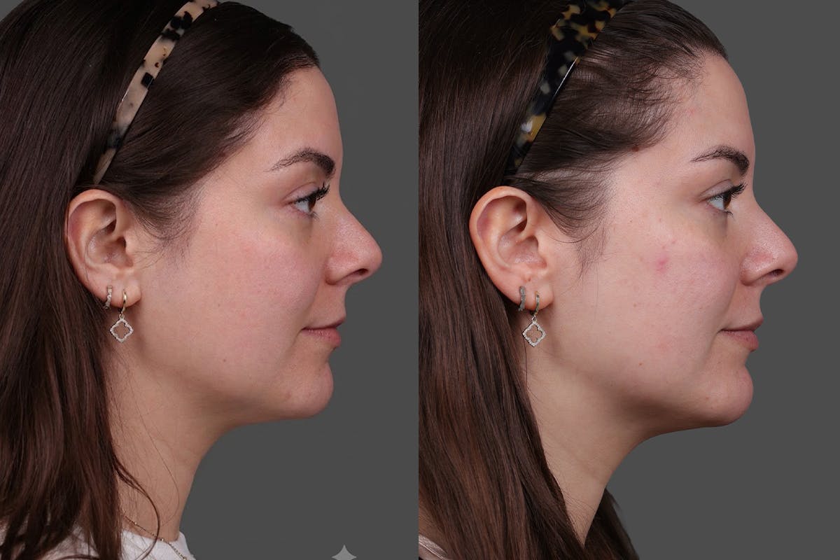 Restylane® Before & After Gallery - Patient 139624 - Image 3