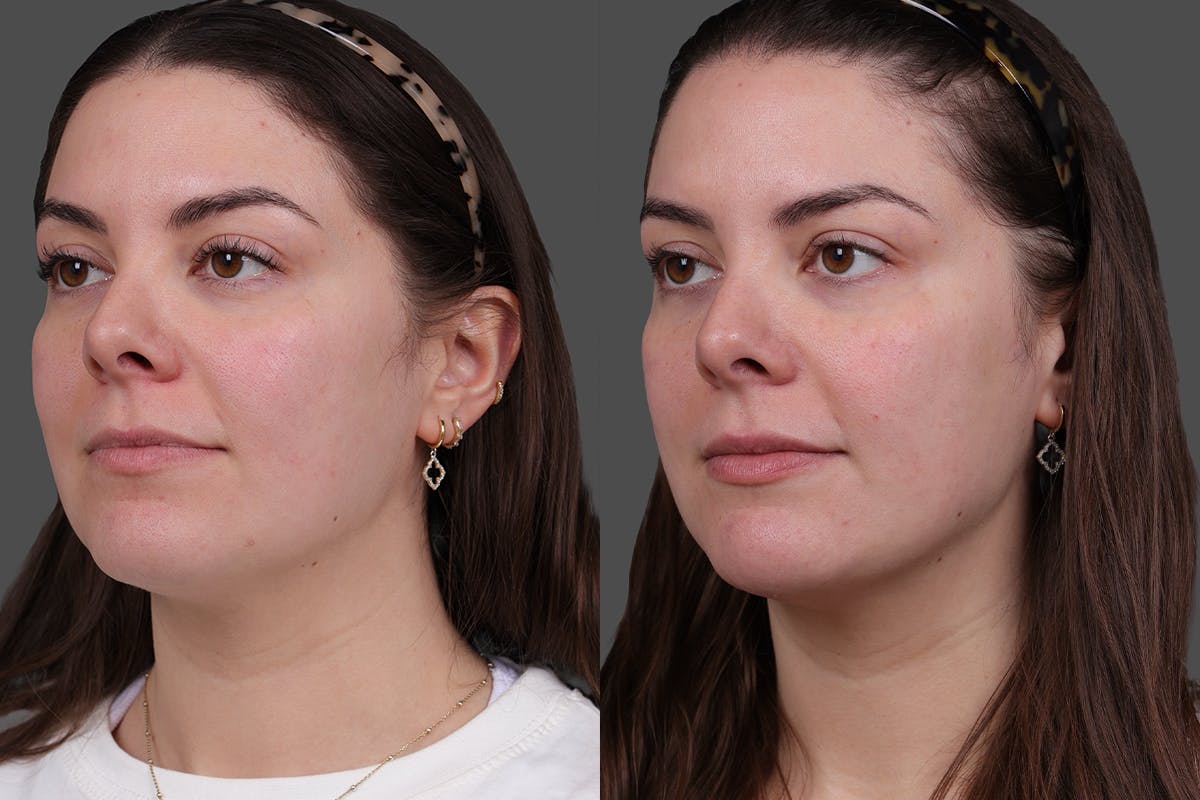 Restylane® Before & After Gallery - Patient 139624 - Image 4