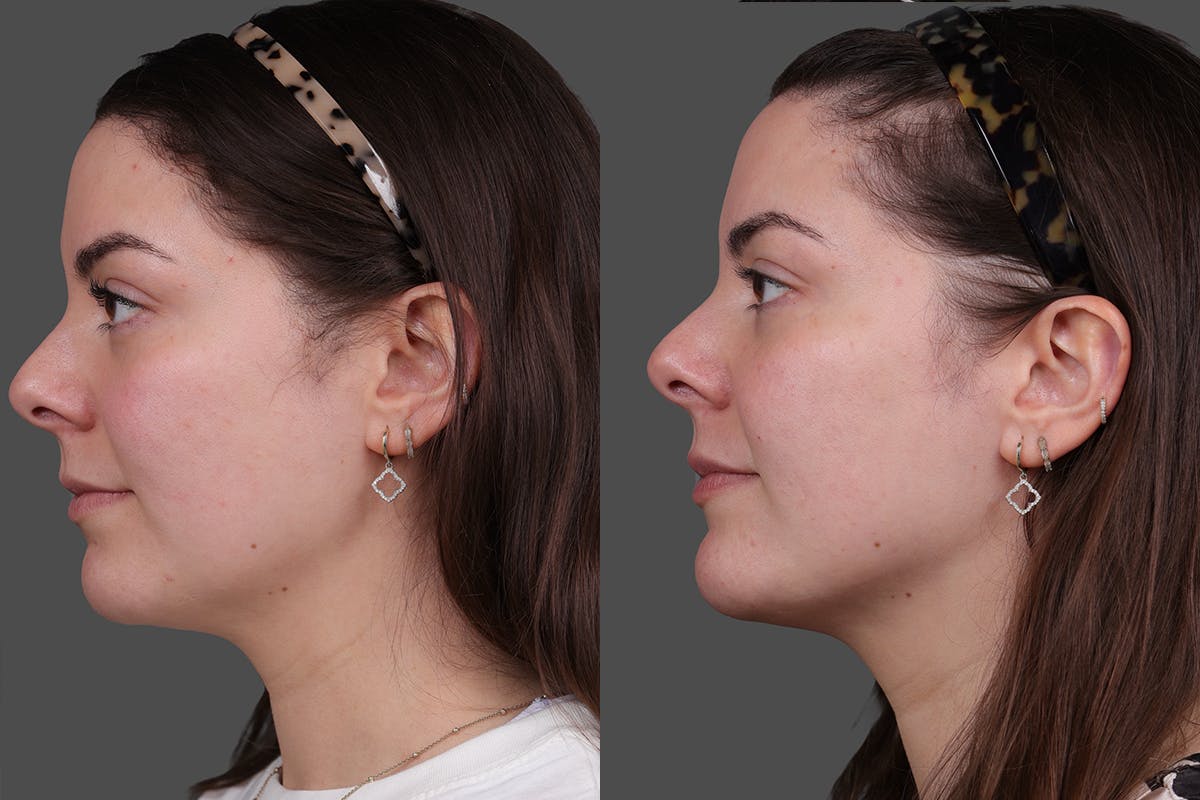 Restylane® Before & After Gallery - Patient 139624 - Image 5