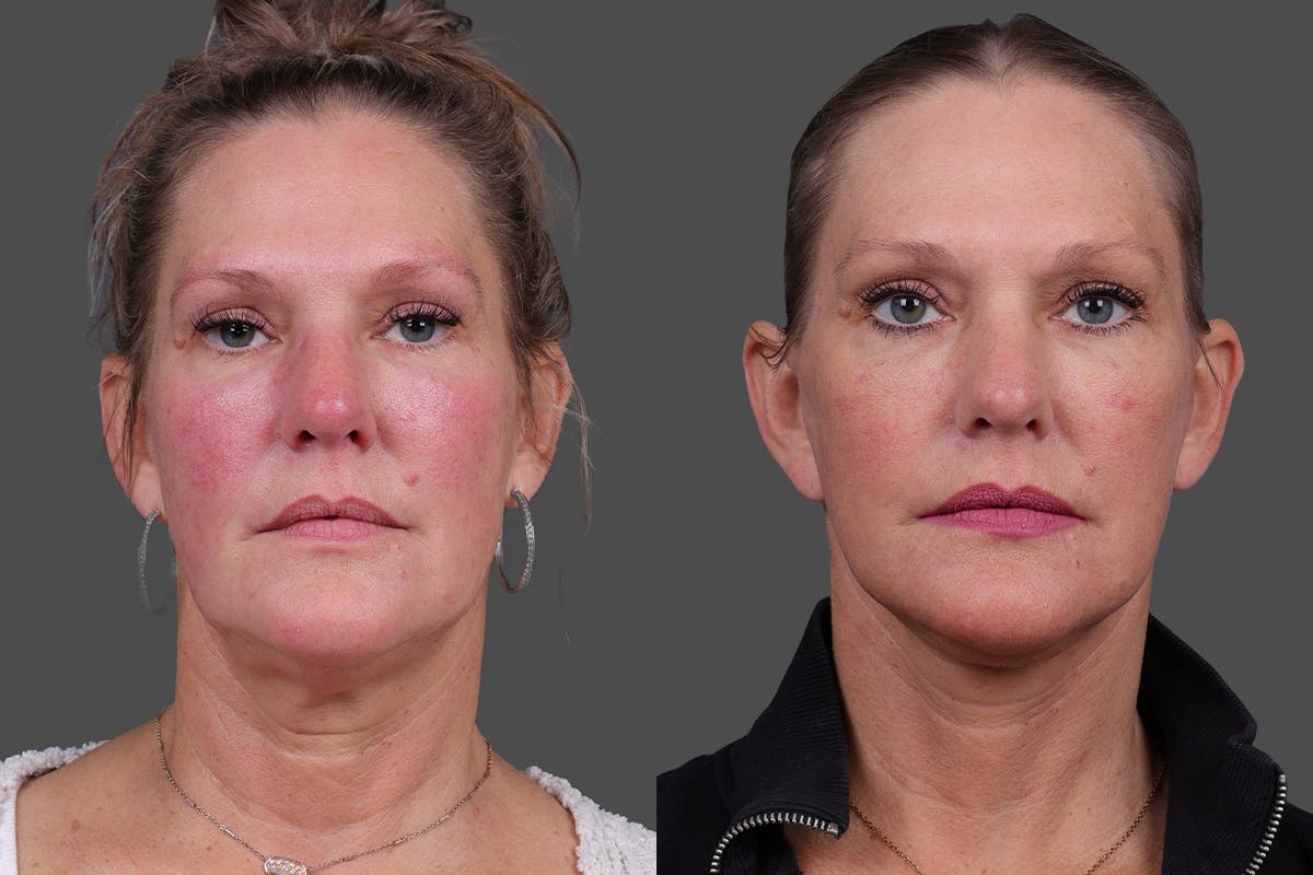 Facelift Before & After Gallery - Patient 275951 - Image 1