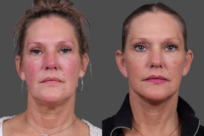 Facelift Before & After Gallery - Patient 275951 - Image 1