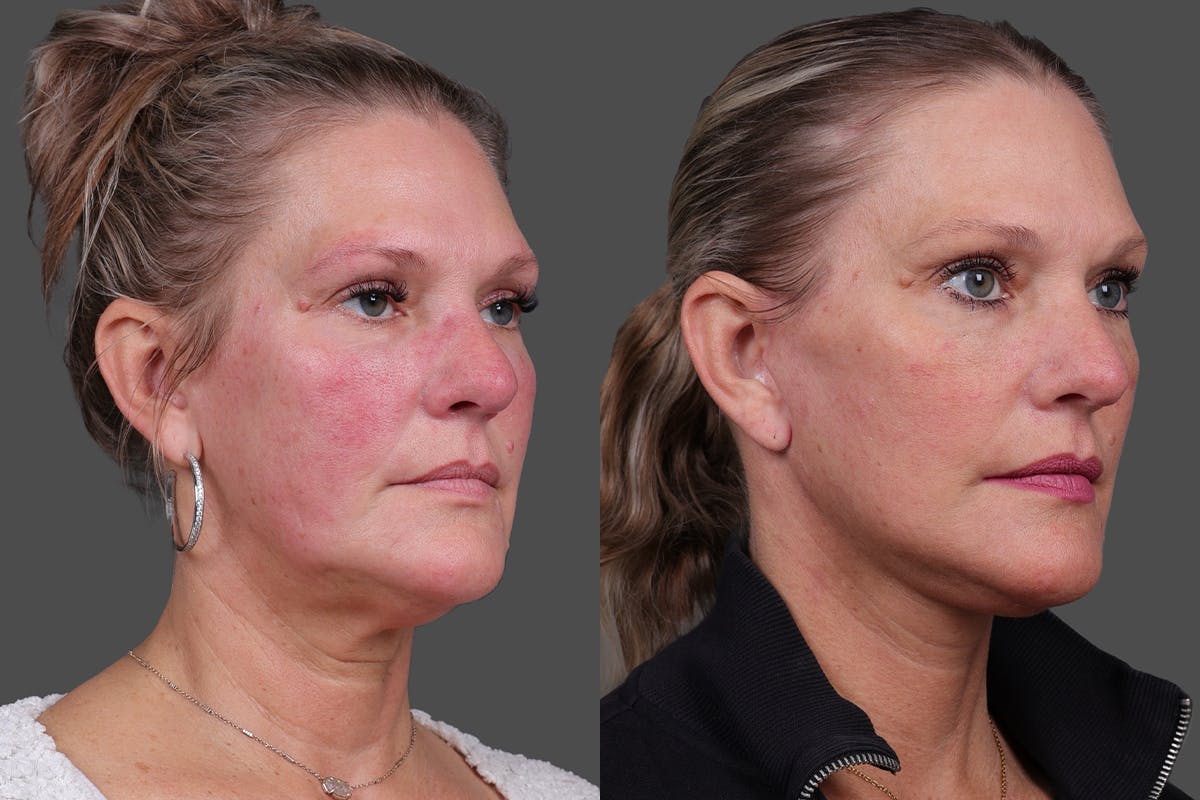 Facelift Before & After Gallery - Patient 275951 - Image 2