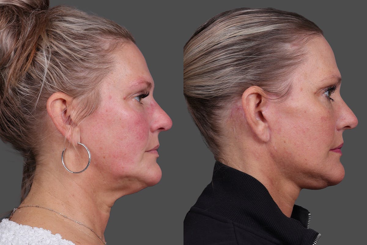 Facelift Before & After Gallery - Patient 275951 - Image 3