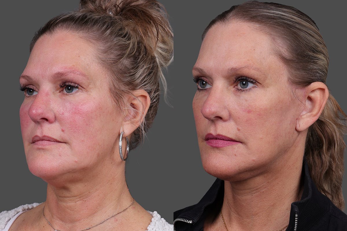 Facelift Before & After Gallery - Patient 275951 - Image 4