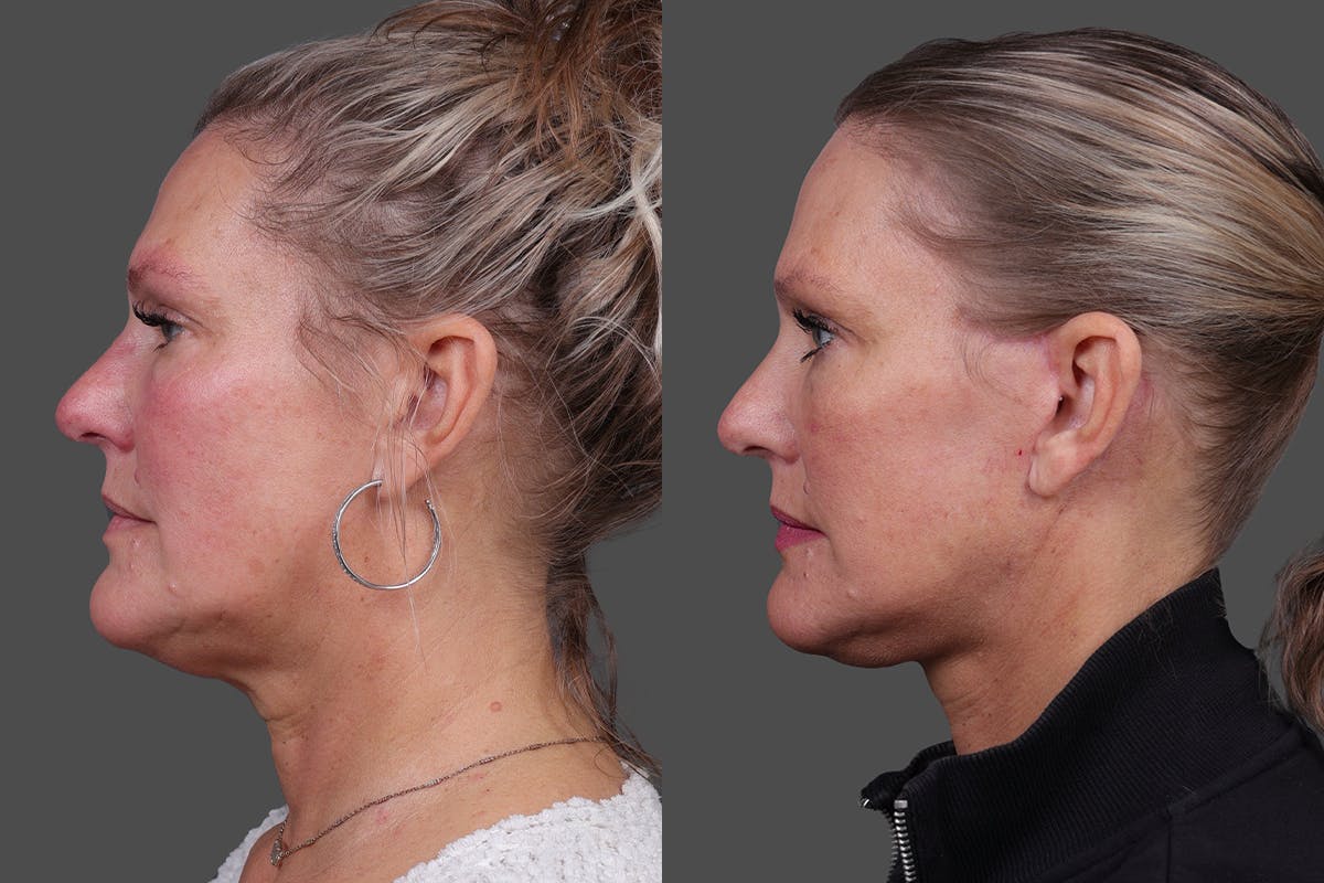 Facelift Before & After Gallery - Patient 275951 - Image 5