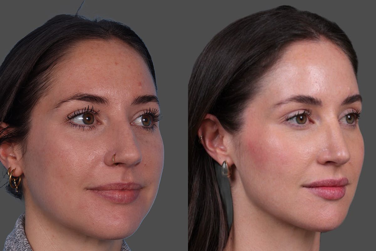 BOTOX® Before & After Gallery - Patient 166300 - Image 2
