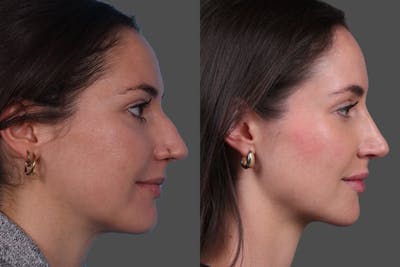 Rhinoplasty Before & After Gallery - Patient 612662 - Image 1