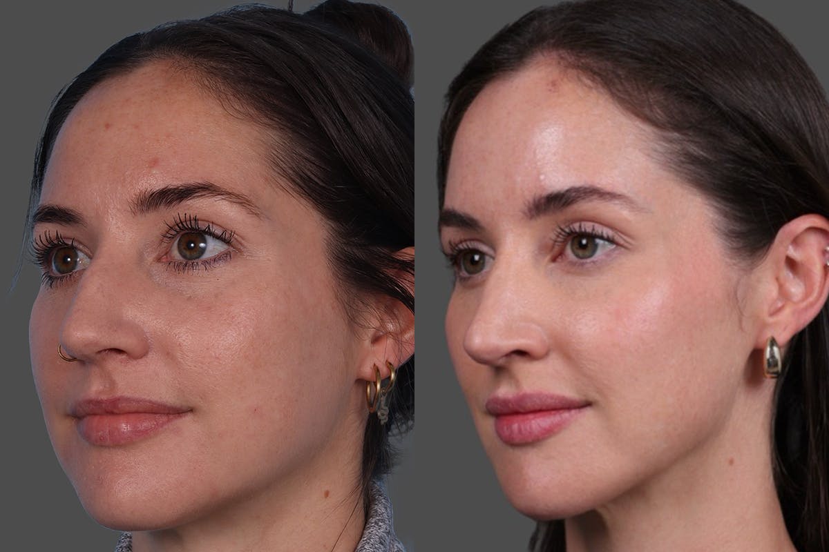 BOTOX® Before & After Gallery - Patient 166300 - Image 4