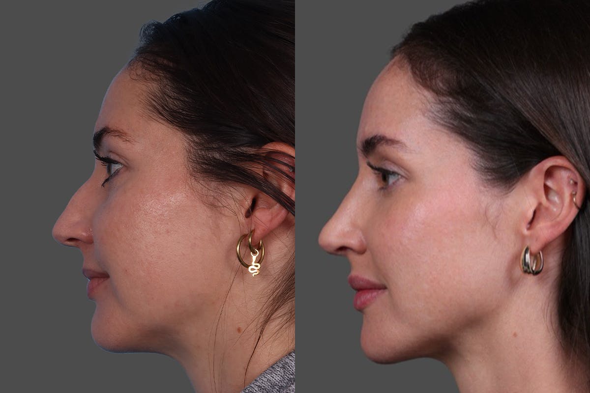 BOTOX® Before & After Gallery - Patient 166300 - Image 5