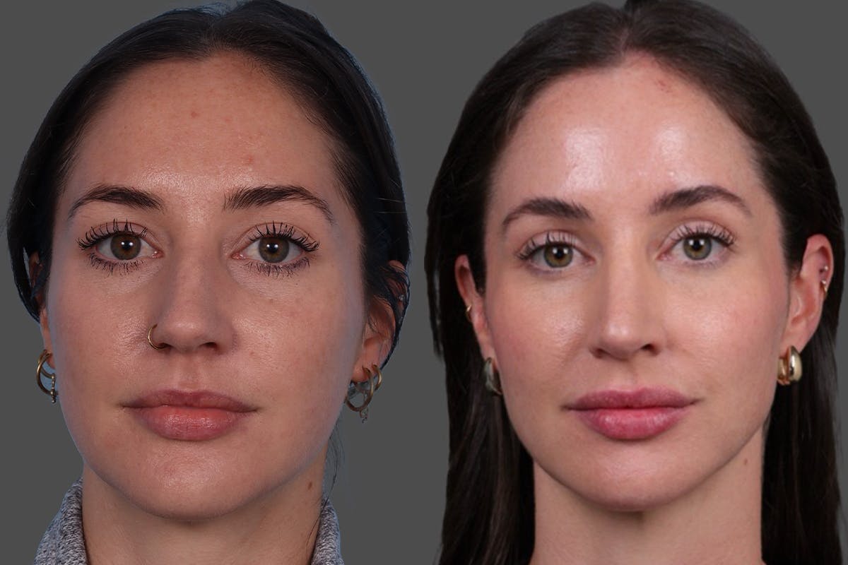 BOTOX® Before & After Gallery - Patient 166300 - Image 1