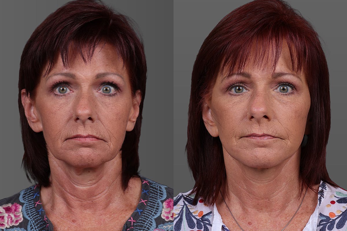 Eyelid Surgery (Blepharoplasty) Before & After Gallery - Patient 278930 - Image 1