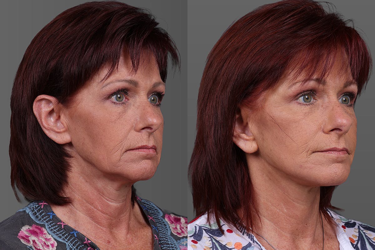 Eyelid Surgery (Blepharoplasty) Before & After Gallery - Patient 278930 - Image 2