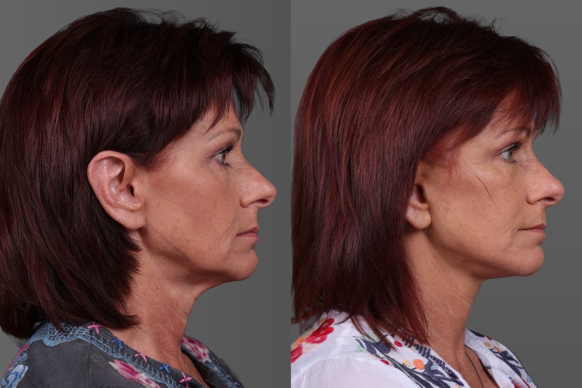 Eyelid Surgery (Blepharoplasty) Before & After Gallery - Patient 278930 - Image 3