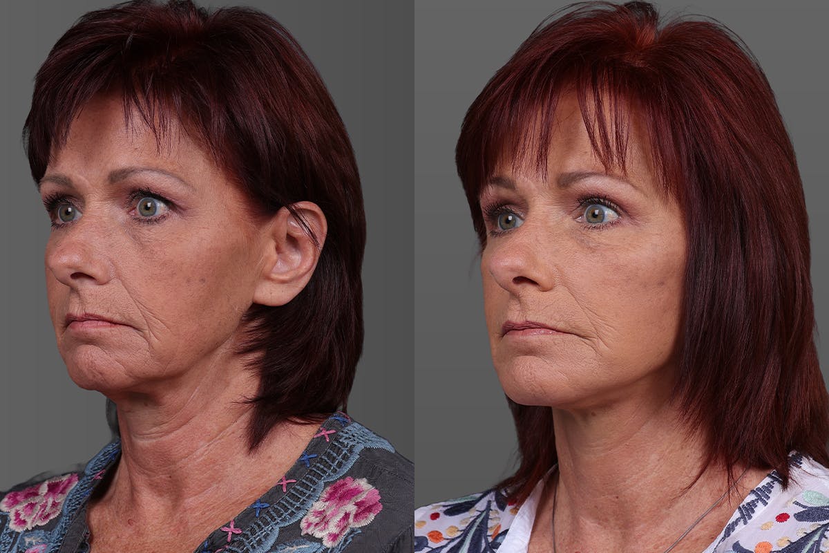 Eyelid Surgery (Blepharoplasty) Before & After Gallery - Patient 278930 - Image 4