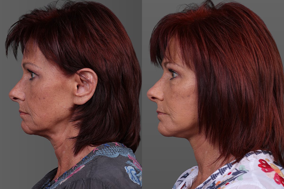 Eyelid Surgery (Blepharoplasty) Before & After Gallery - Patient 278930 - Image 5