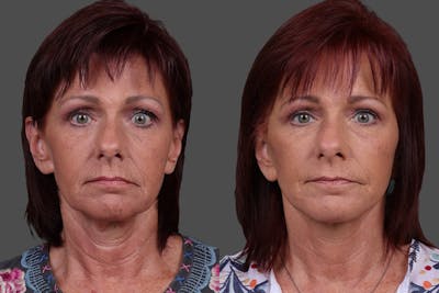 Facelift Before & After Gallery - Patient 213855 - Image 1