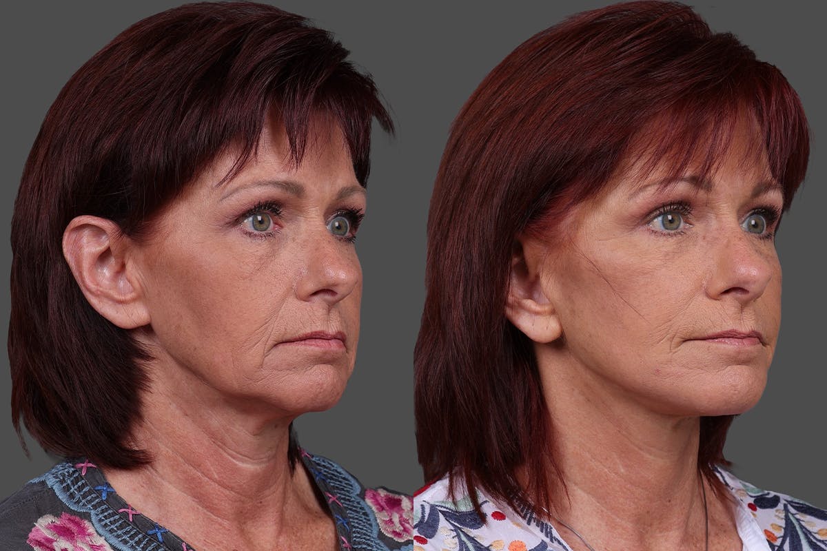 Eyelid Surgery (Blepharoplasty) Before & After Gallery - Patient 278930 - Image 2